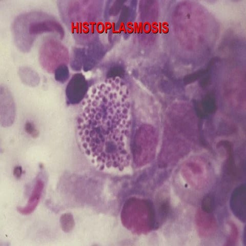 Clase 18 histoplasmosis 2015