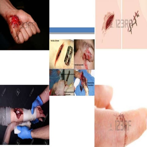 CLASE_7_PBM_HERIDAS_I.pptx, clase hesidas