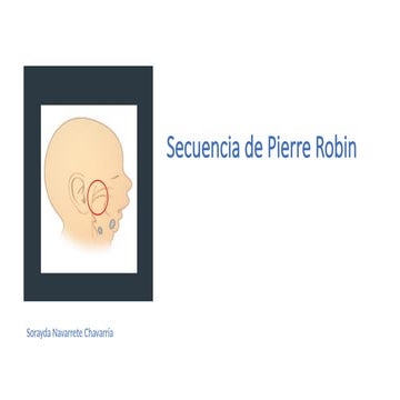 Secuencia de Pierre Robin y algoritmo de tratamiento | PPTX
