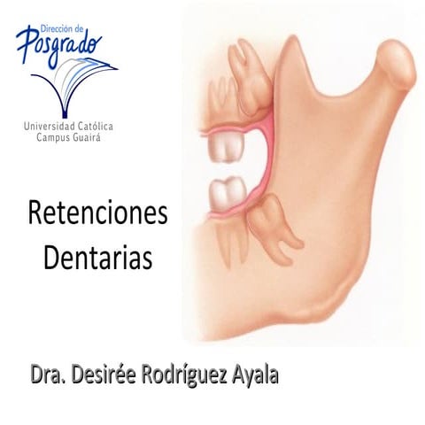 Dientes Retenidos