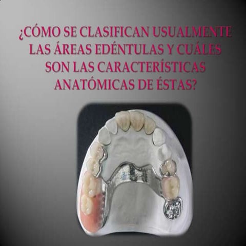Clasificación de áreas edéntulas | PPTX