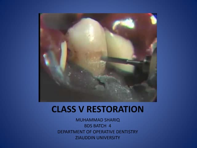 Class v-restoration - Operative  