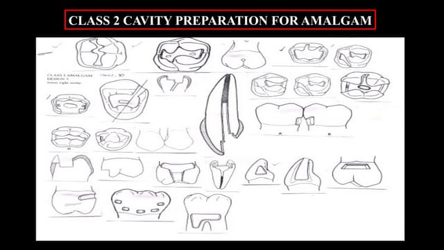 Class II cavity preparation | PPTX