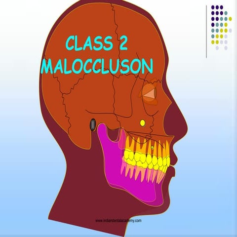 Class2 malocclusion /certified fixed orthodontic courses by Indian dental aca...
