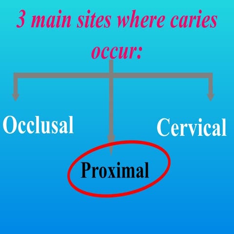 CLASS II CAVITY PREPARATION for  amalgam