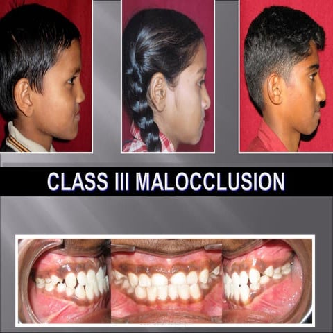 Class iii malocclusion   /certified fixed orthodontic courses by Indian denta...