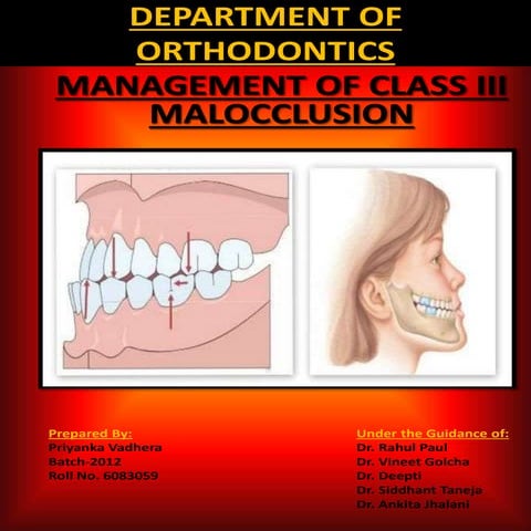 Class III Malocclusion