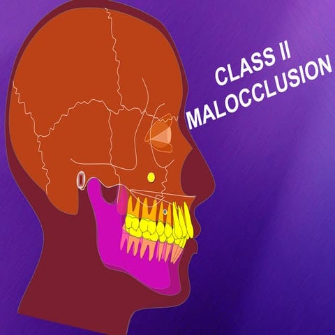 Class 2 malocclusion