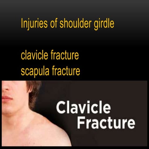 Clavicle fracture
