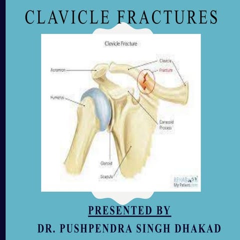 clavicle fracture new -1.pptx