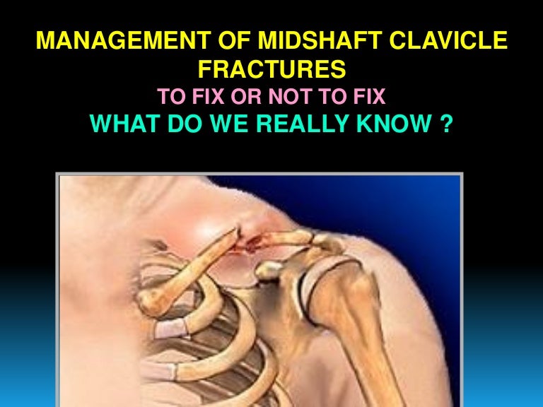 Clavicle fractures