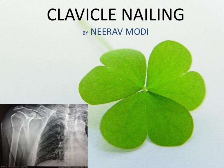 Clavicle nailing