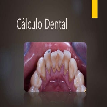 Cálculo dental Periodoncia