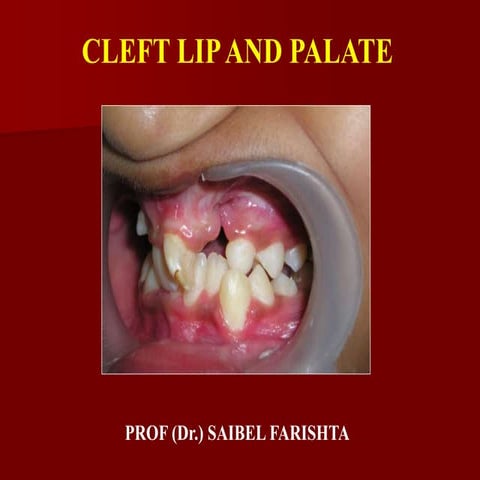 Cleft Lip & Palate