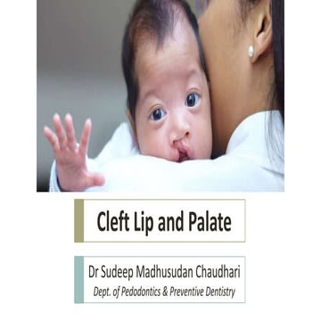 Cleft lip and palate