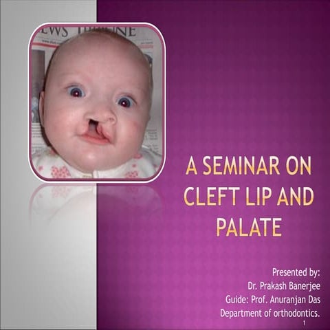 CLEFT LIP AND PALATE - etiology and managemnt | PPT