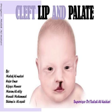 cleft lip and palate Management of Cleft Lip and Palate | PPTX