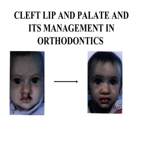 Cleft lip & palate management in orthodontics