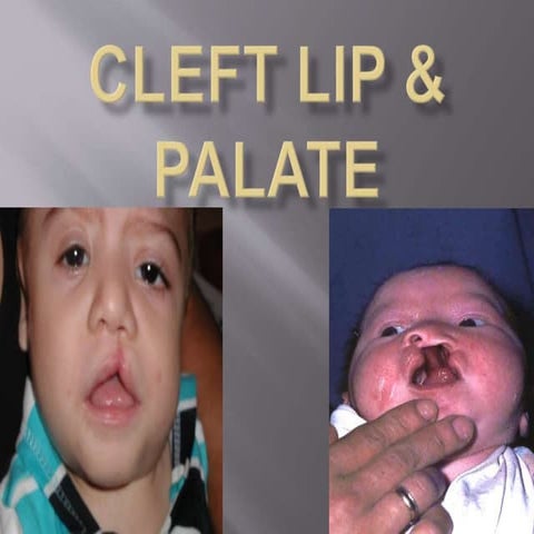 Cleft lip and palate