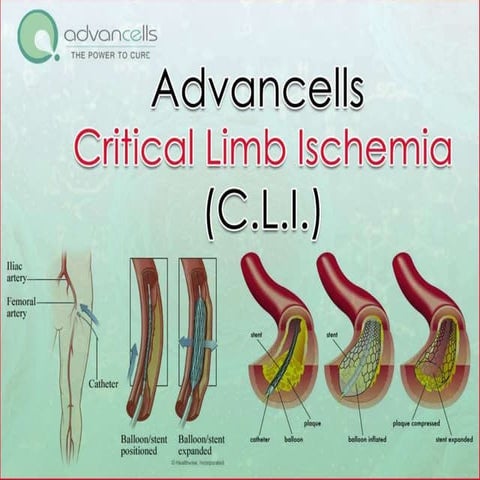 Critical Limb Ischemia (CLI)