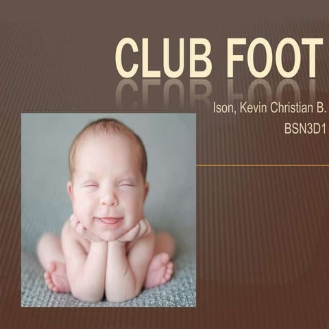 Club foot