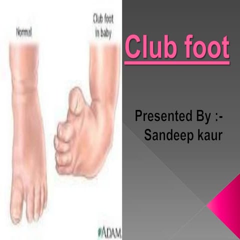 Club foot