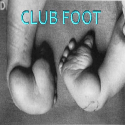 Club foot