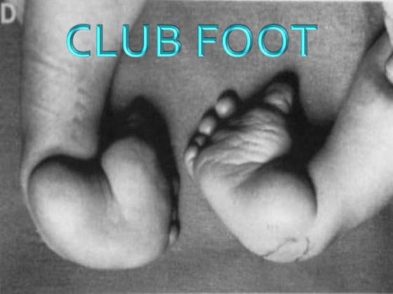 Club Foot | PDF
