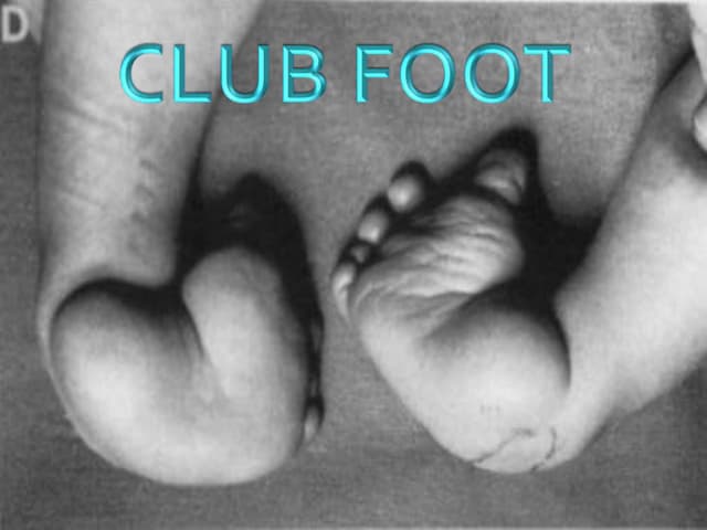 Club foot | PPTX