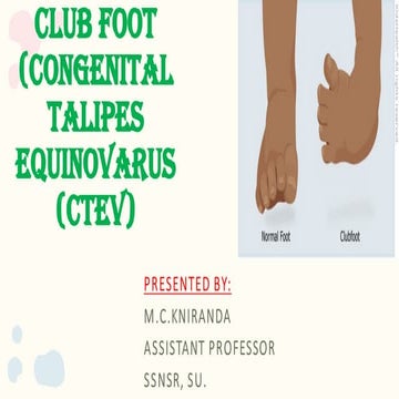 Club foot | PPTX