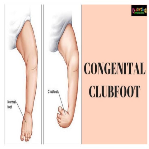 Club foot detailed lecture power point.pptx