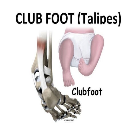 Club Foot 1