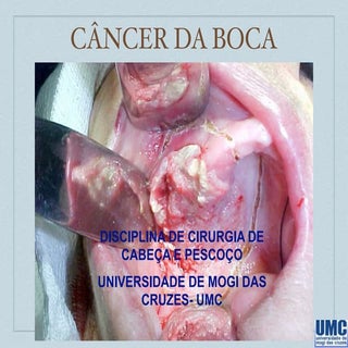 Câncer de boca  6 ano