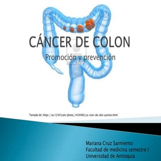 Cáncer de colon prevención 