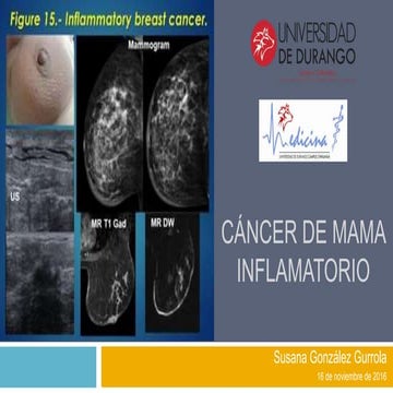 Cáncer de mama inflamatorio