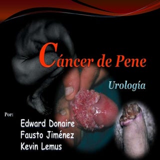 Cáncer de Pene