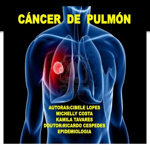 Cáncer de pulmón slide 