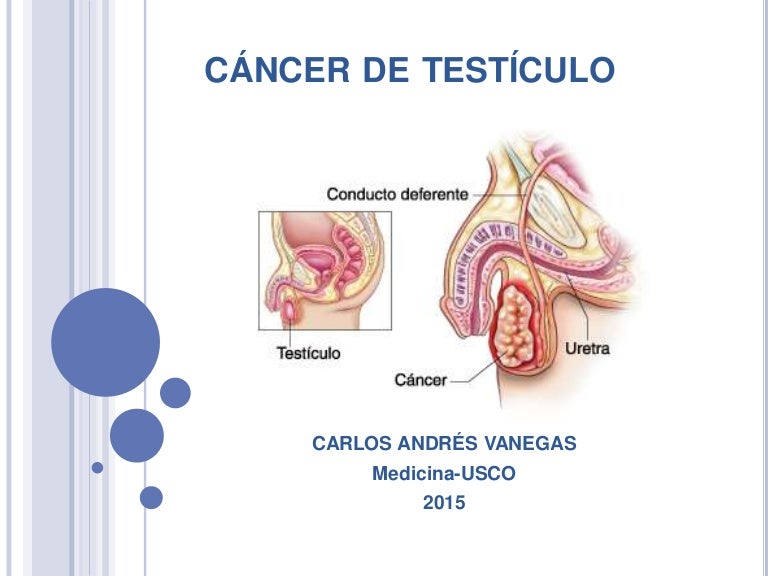 cancer de testiculo sintomas y tratamiento