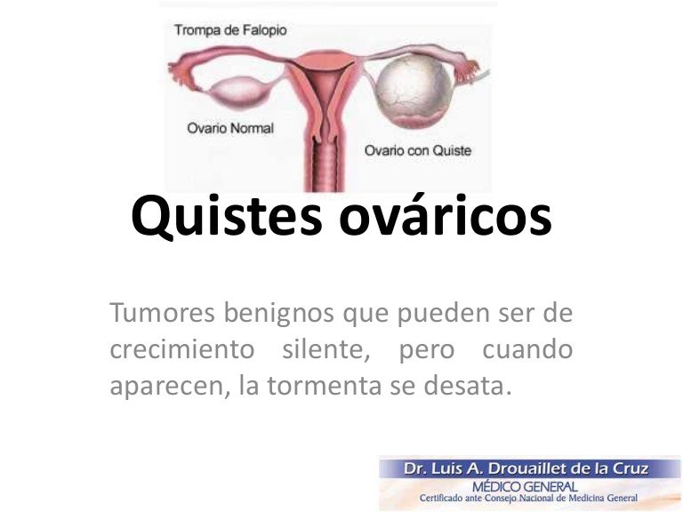 quiste en los ovarios en ingles quiste en los ovarios en ingles