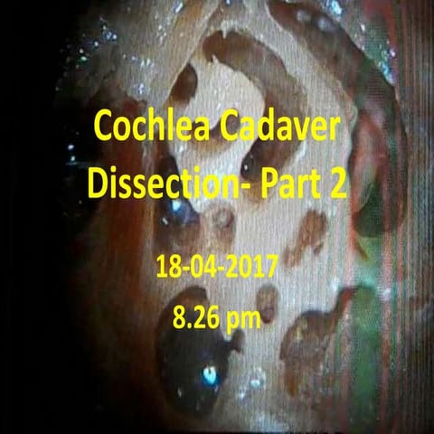 Cochlea cadaver dissection - part 2