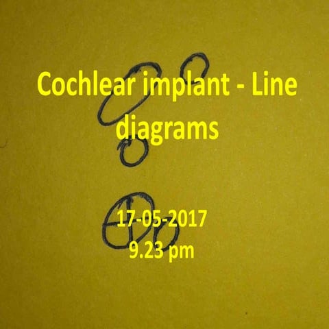 Cochlear implant - line diagrams