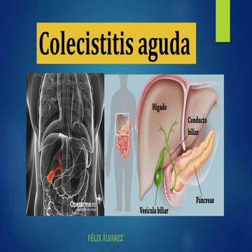 Colecistitis 1
