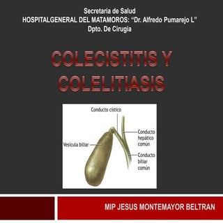 Colecistitis y colelitiasis