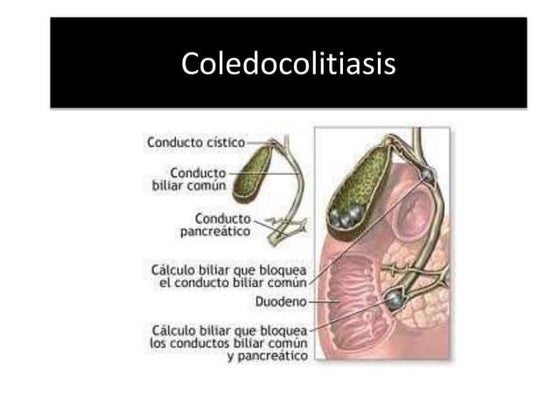 Esfinterotomia Coledoco Pâncreas Divisum – Diagnóstico E