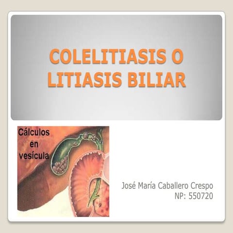 Colelitiasis