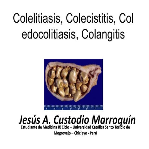 Colelitiasis