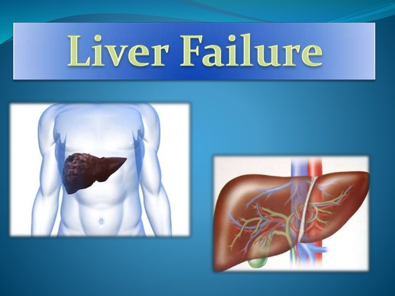 Liver Failure AlexMed 890904
