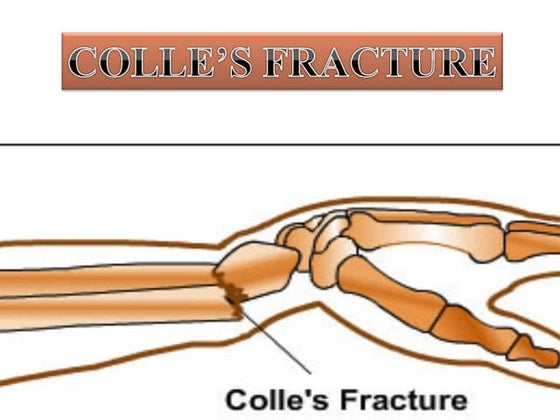 Colles' fracture | PPT