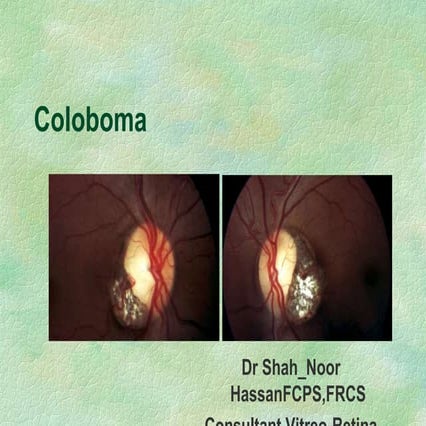 Coloboma PPT