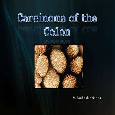 Colon cancer